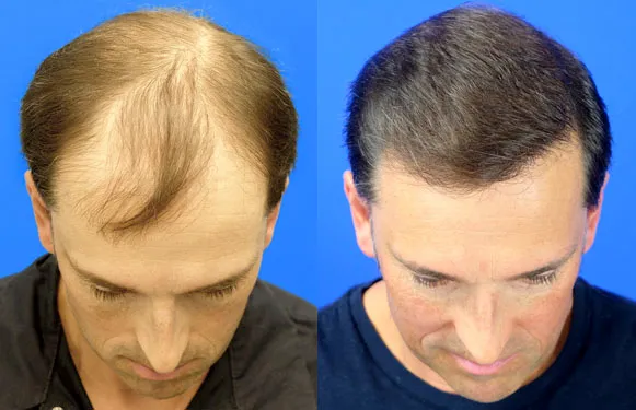 vancouver-hair-transplant-before-and-after-surgery